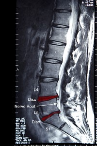 Chiropractic Covington GA Spine X-Ray Chiropractic Covington GA Spine X-Ray